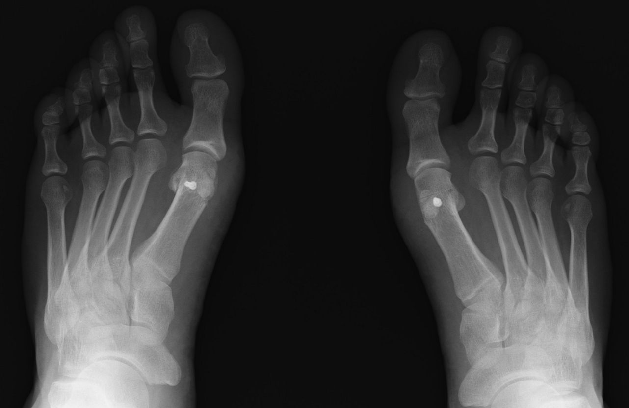 rentgen stopala s bolovima u zglobovima
